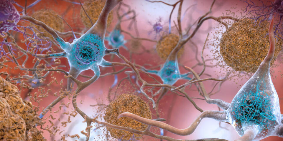 Alzheimer’s Breakthrough: Arginine’s Wild Potential
