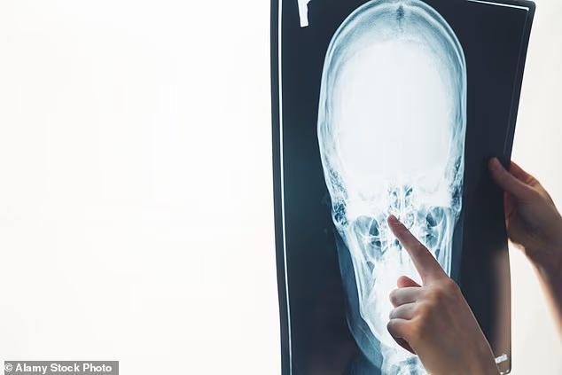 Head Injuries & Dementia: What You Need to Know