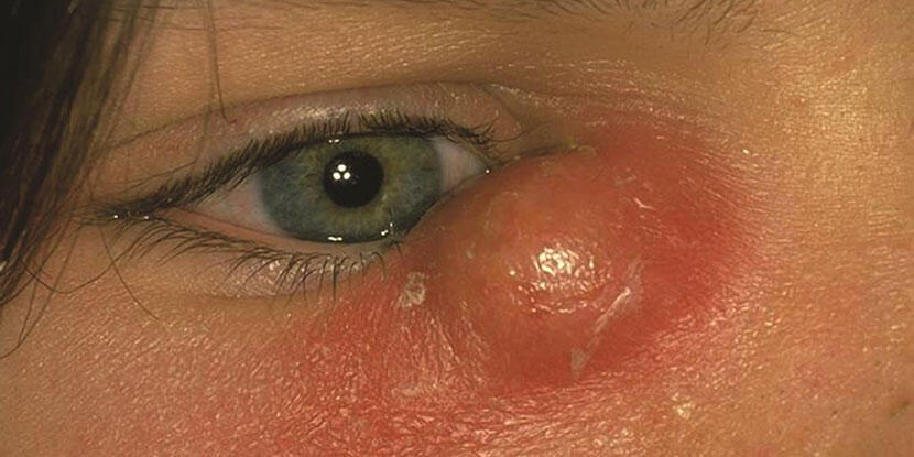 Why Are Women Getting This Eye Infection More?