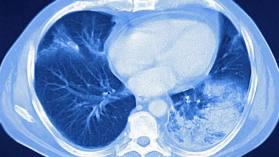 Steroids: Secret Weapon for Severe Pneumonia?
