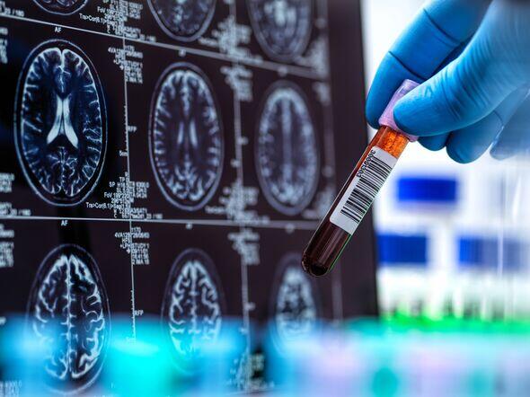 Alzheimer's Blood Test: Game Changer?