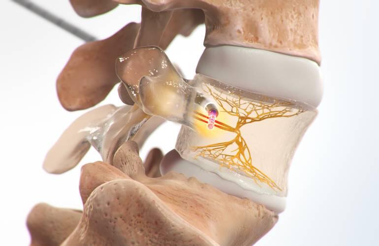 Back Pain Relief Just Got Way Easier